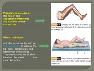 Percutaneous release of
Hip flexion and
abduction contractures
and Achilles tendon
contracture

Rideau technique
a similar technique, but with an
open procedure to release the
hip flexor contractures and
lateral thigh contractures.
They also excised the iliotibial
band and the lateral
inter
muscular septum

 