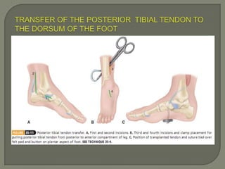 Duchenne muscular dystrophy