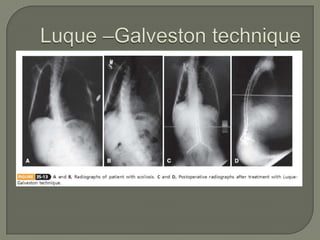 Duchenne muscular dystrophy