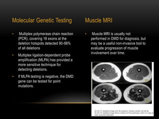 • Muscle MRI is usually not
performed in DMD for diagnosis, but
may be a useful non-invasive tool to
evaluate progression of muscle
involvement over time.
• Multiplex polymerase chain reaction
(PCR), covering 18 exons at the
deletion hotspots detected 90-98%
of all deletions
• Multiplex ligation-dependent probe
amplification (MLPA) has provided a
more sensitive technique for
detecting deletions.
• If MLPA testing is negative, the DMD
gene can be tested for point
mutations.
Molecular Genetic Testing Muscle MRI
 