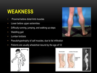 WEAKNESS
• Proximal before distal limb muscles
• Lower before upper extremities
• Difficulty running, jumping, and walking up steps
• Waddling gait
• Lumbar lordosis
• Pseudohypertrophy of calf muscles, due to fat infiltration
• Patients are usually wheelchair-bound by the age of 12
 