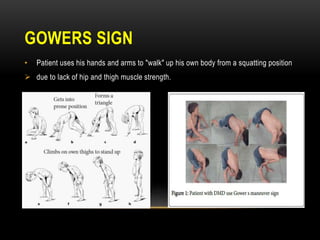 GOWERS SIGN
• Patient uses his hands and arms to "walk" up his own body from a squatting position
 due to lack of hip and thigh muscle strength.
 
