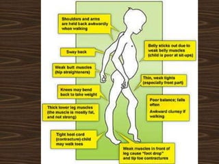 Duchenne muscular dystrophy | PPTX