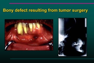Bony defect resulting from tumor surgery
 
