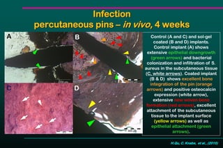 Infection
percutaneous pins – in vivo, 4 weeks
Control (A and C) and sol-gel
coated (B and D) implants.
Control implant (A) shows
extensive epithelial downgrowth
(green arrows) and bacterial
colonization and infiltration of S.
aureus in the subcutaneous tissue
(C, white arrows). Coated implant
(B & D) shows excellent bone
integration of the pin (orange
arrows) and positive osteocalcin
expression (white arrow),
extensive new woven bone
formation (red arrows), excellent
attachment of the subcutaneous
tissue to the implant surface
(yellow arrows) as well as
epithelial attachment (green
arrows).
A
C
B
D
H.Qu, C. Knabe, et al., (2015)
 