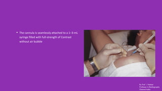 • The cannula is seamlessly attached to a 1–3-mL
syringe filled with full-strength of Contrast
without air bubble
By Prof J Venkat
Professor in Radiography
Chennai India
 