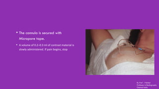 • The cannula is secured with
Micropore tape.
• A volume of 0.2–0.3 ml of contrast material is
slowly administered. If pain begins, stop
By Prof J Venkat
Professor in Radiography
Chennai India
 
