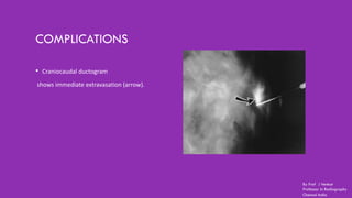 COMPLICATIONS
• Craniocaudal ductogram
shows immediate extravasation (arrow).
By Prof J Venkat
Professor in Radiography
Chennai India
 