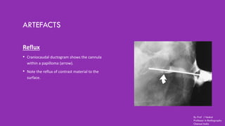 ARTEFACTS
Reflux
• Craniocaudal ductogram shows the cannula
within a papilloma (arrow).
• Note the reflux of contrast material to the
surface.
By Prof J Venkat
Professor in Radiography
Chennai India
 