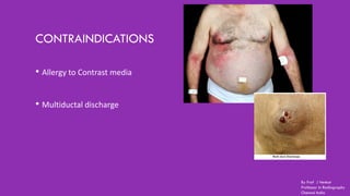 CONTRAINDICATIONS
• Allergy to Contrast media
• Multiductal discharge
By Prof J Venkat
Professor in Radiography
Chennai India
 