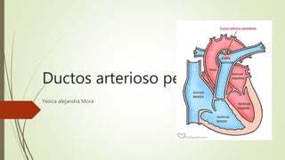 Ductos arterioso persistente
Yesica alejandra Mora
 