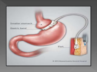 Gastrointestinal System Disorders | PPTX