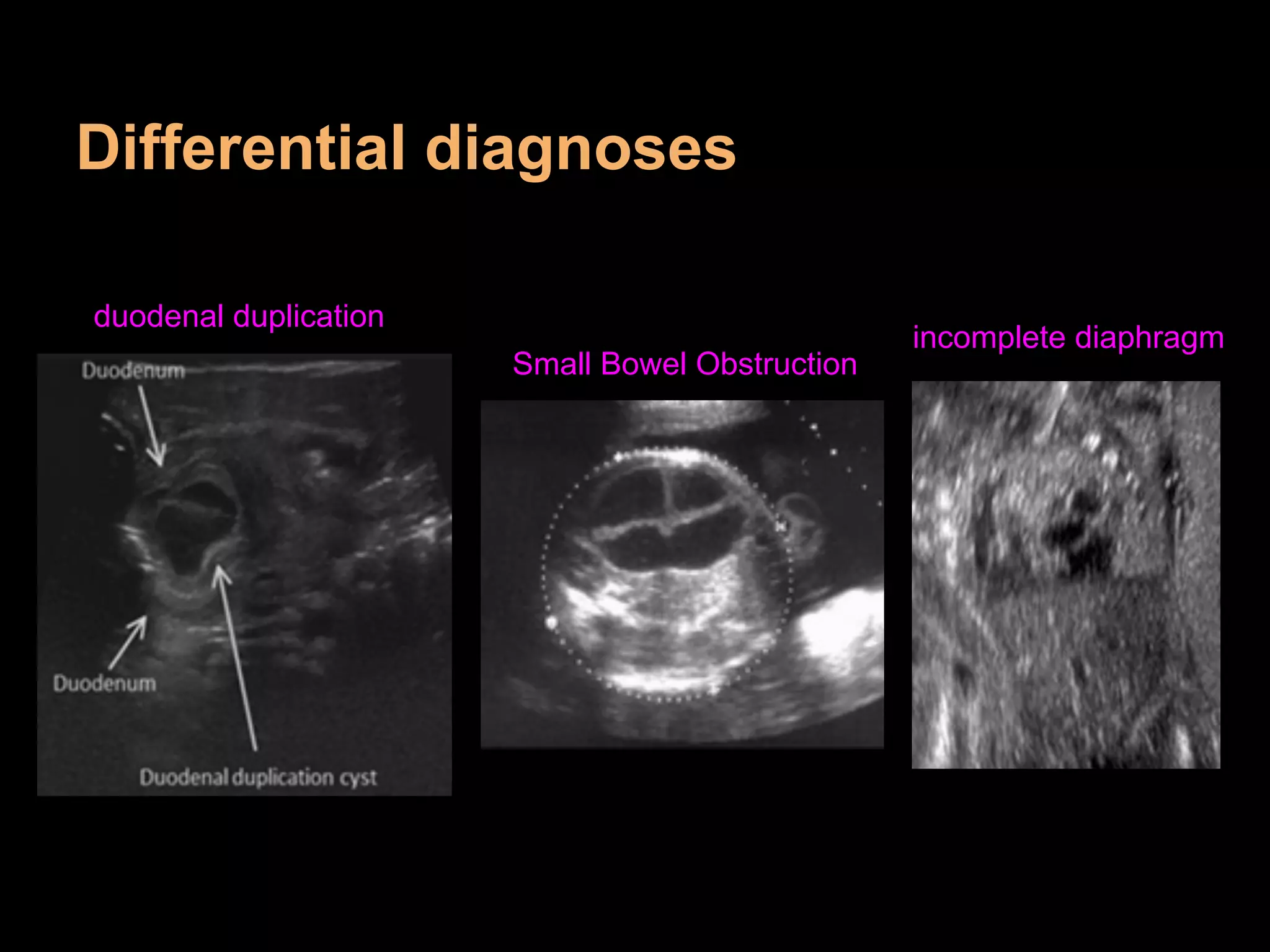Differential diagnoses
Small Bowel Obstruction
duodenal duplication
incomplete diaphragm