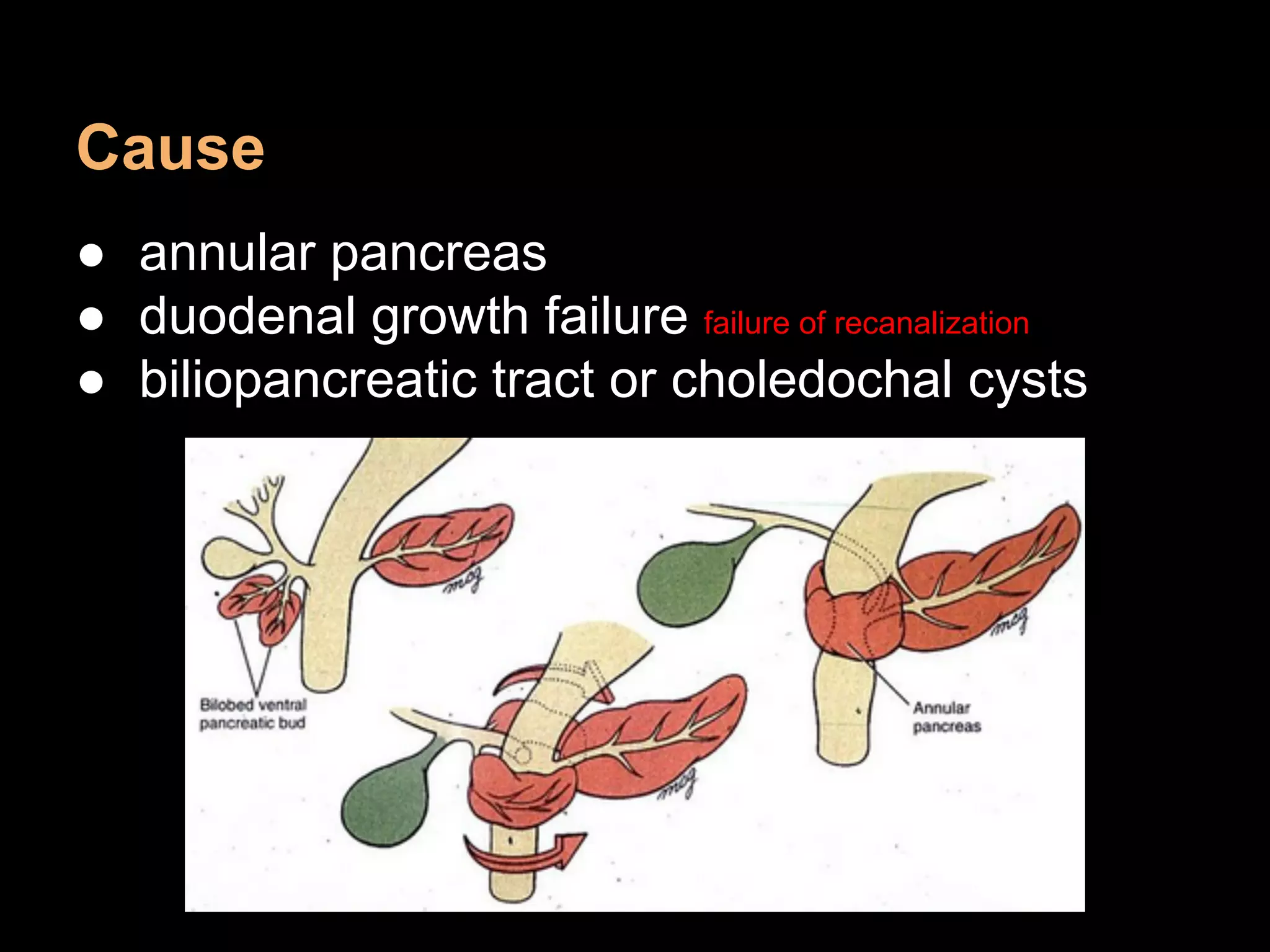 Cause
● annular pancreas
● duodenal growth failure failure of recanalization
● biliopancreatic tract or choledochal cysts