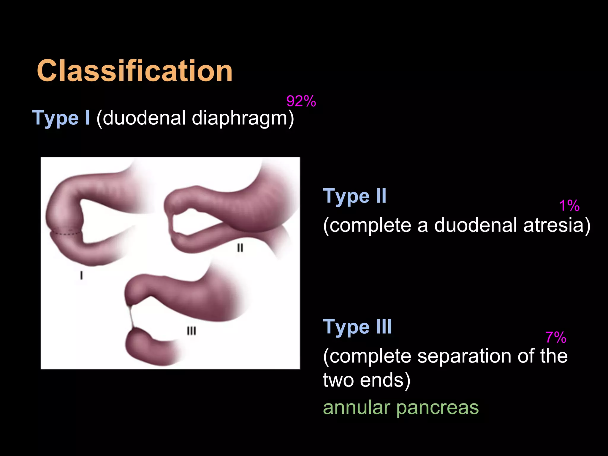 Classification
Type I (duodenal diaphragm)
Type II
(complete a duodenal atresia)
Type III
(complete separation of the
two ends)
annular pancreas
92%
1%
7%