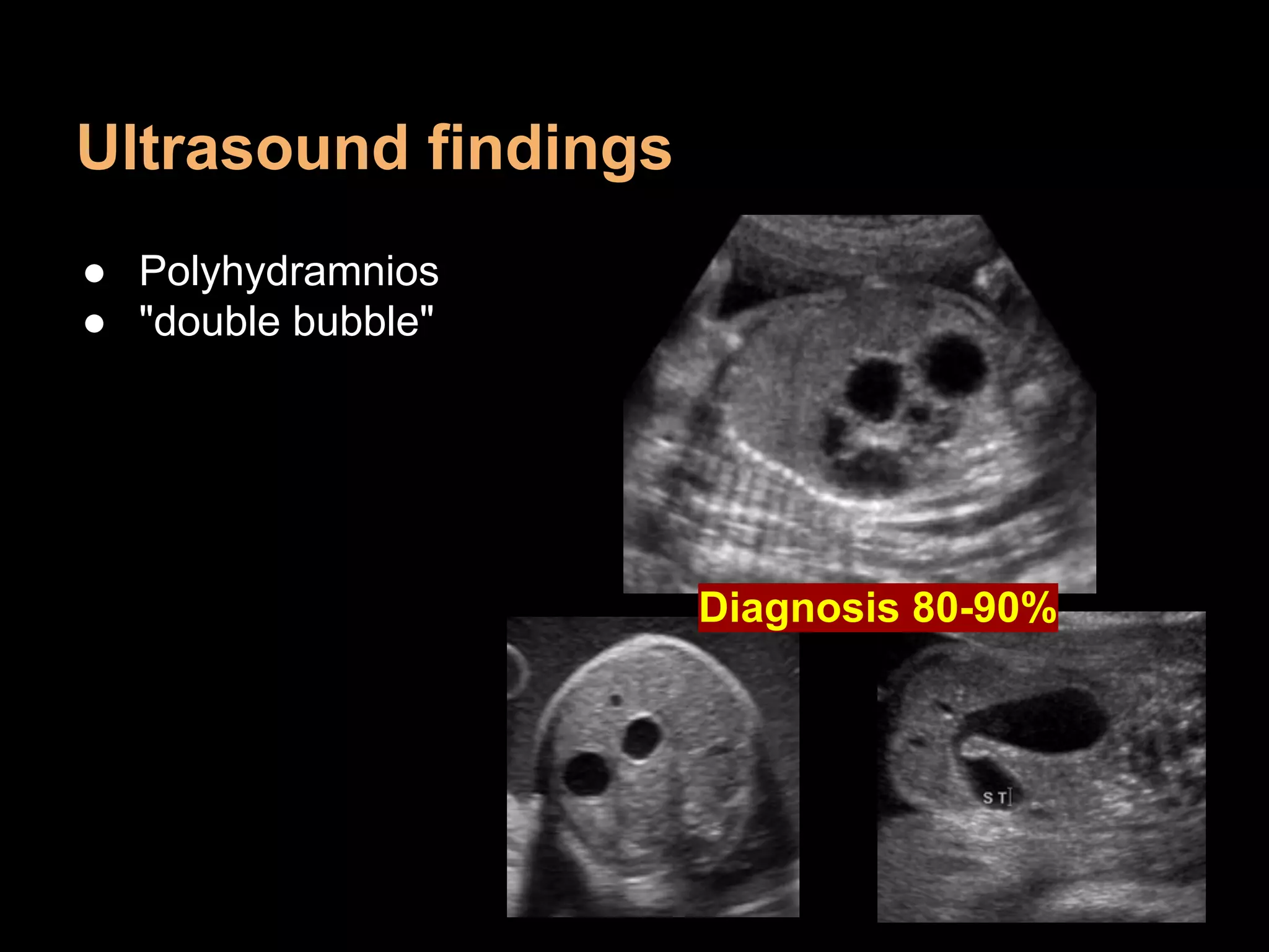 Ultrasound findings
● Polyhydramnios
● "double bubble"
Diagnosis 80-90%