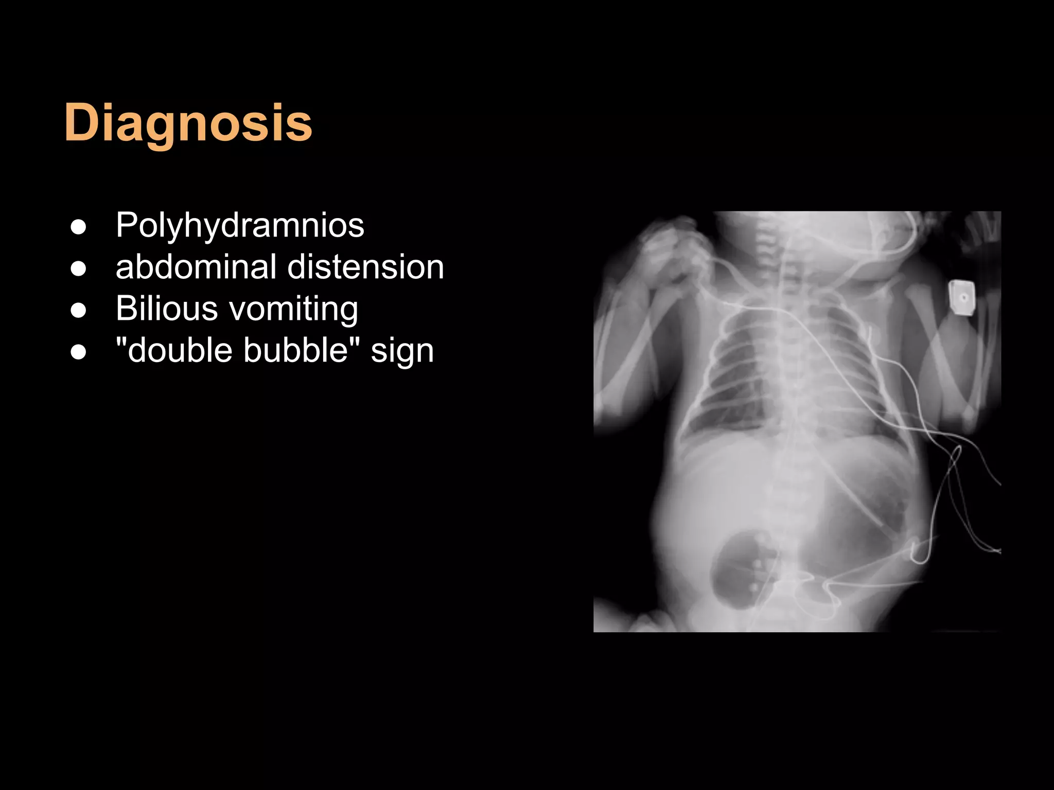 Diagnosis
● Polyhydramnios
● abdominal distension
● Bilious vomiting
● "double bubble" sign