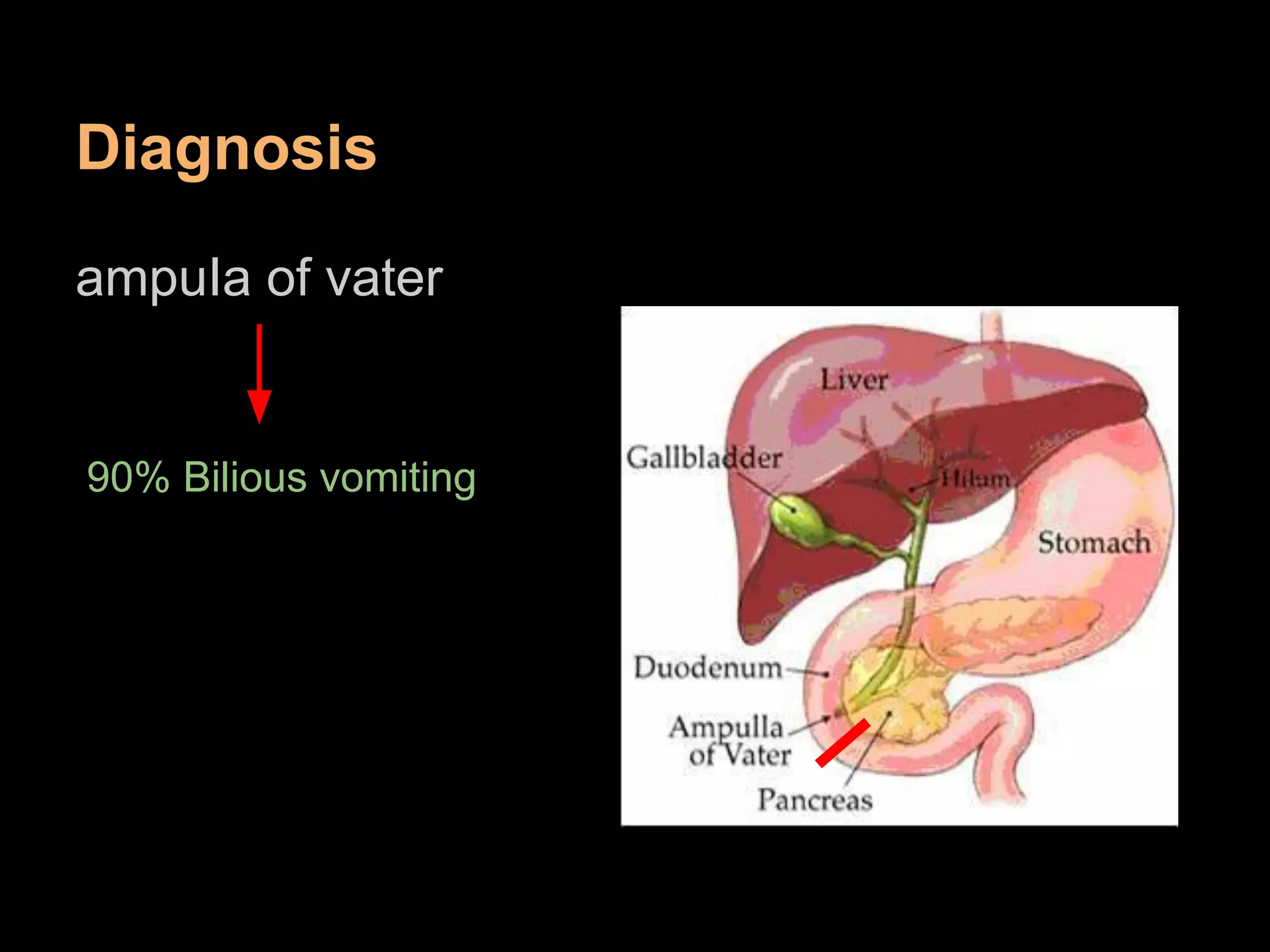 Diagnosis
ampuIa of vater
90% Bilious vomiting