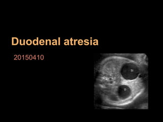 Duodenal atresia
20150410
 