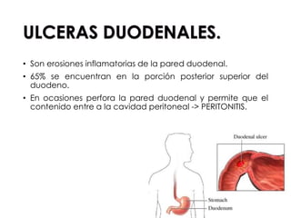 • Son erosiones inflamatorias de la pared duodenal.
• 65% se encuentran en la porción posterior superior del
duodeno.
• En ocasiones perfora la pared duodenal y permite que el
contenido entre a la cavidad peritoneal -> PERITONITIS.
 