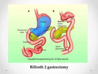Billroth 2 gastrectomy
 