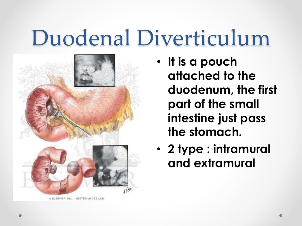 Duodenum and duodenal diverticulum