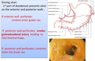 Kissing ulcer:
1st part of duodenum presents ulcer
on the anterior and posterior walls .
If anterior wall perforate:
content enter grater sac.
If posterior wall perforates: erodes
gastroduodenal artery leading to
fatal haemorrhage.
If posterior wall perforates: contents
enter the lesser sac.
 