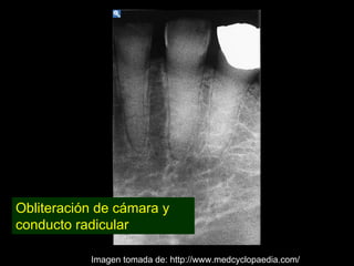 Dentinogénesis Imperfecta 