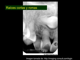 Dentinogénesis Imperfecta 