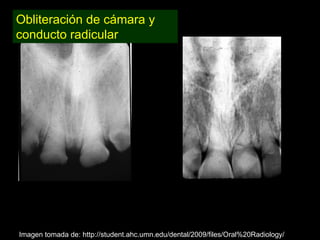 Dentinogénesis Imperfecta 