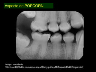 Dentinogénesis Imperfecta 