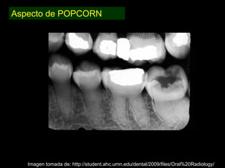 Dentinogénesis Imperfecta 