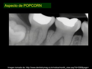 Dentinogénesis Imperfecta 