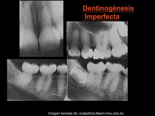 Dentinogénesis Imperfecta 