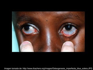 Dentinogénesis Imperfecta 