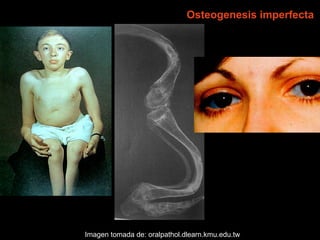 Dentinogénesis Imperfecta 