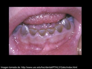 Dentinogénesis Imperfecta 