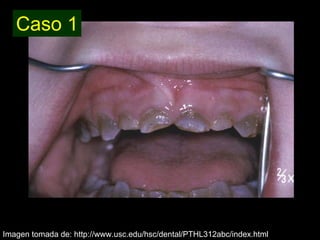 Dentinogénesis Imperfecta 