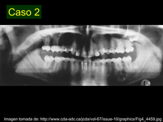 Dentinogénesis Imperfecta 