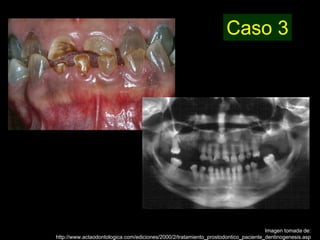 Dentinogénesis Imperfecta 