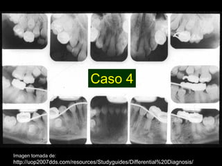 Dentinogénesis Imperfecta 