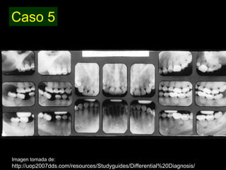 Dentinogénesis Imperfecta 