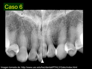 Dentinogénesis Imperfecta 