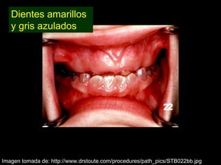 Dentinogénesis Imperfecta 