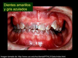 Dentinogénesis Imperfecta 