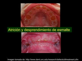 Dentinogénesis Imperfecta 
