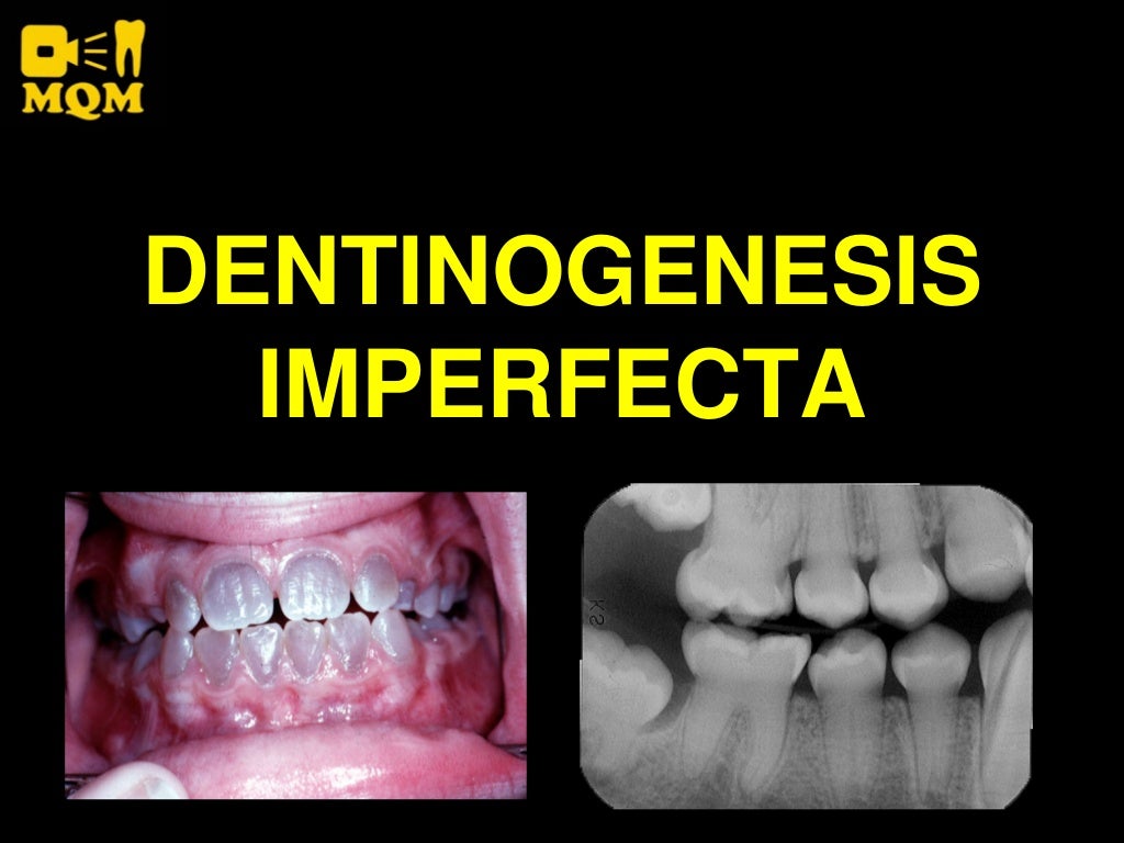 Dentinogénesis Imperfecta