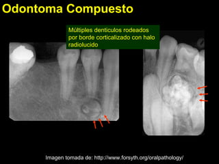 Odontoma