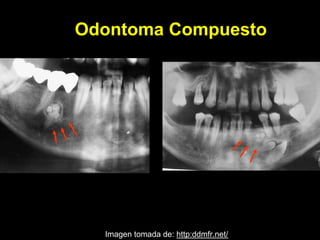 Odontoma
