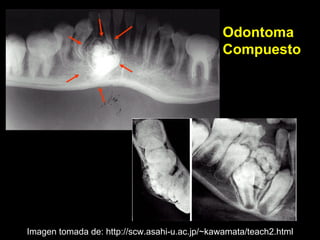 Odontoma